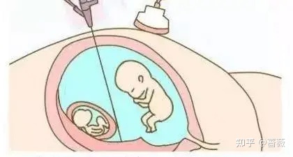 试管婴儿怎么减胎？